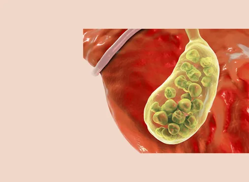 CBD Stones (Choledocholithiasis) consultation at Niraaya Hospital